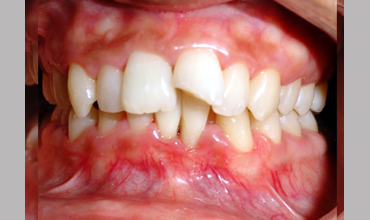 Orthodontic services in Anand
                